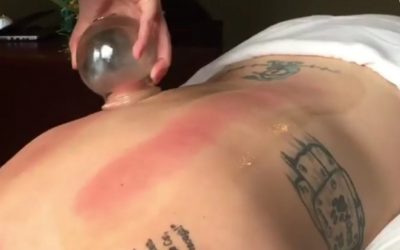 Slide Cupping with Dr. Sarah ND