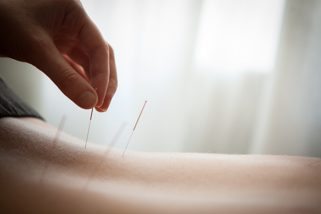 Acupuncture